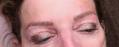 eyebrow treatement